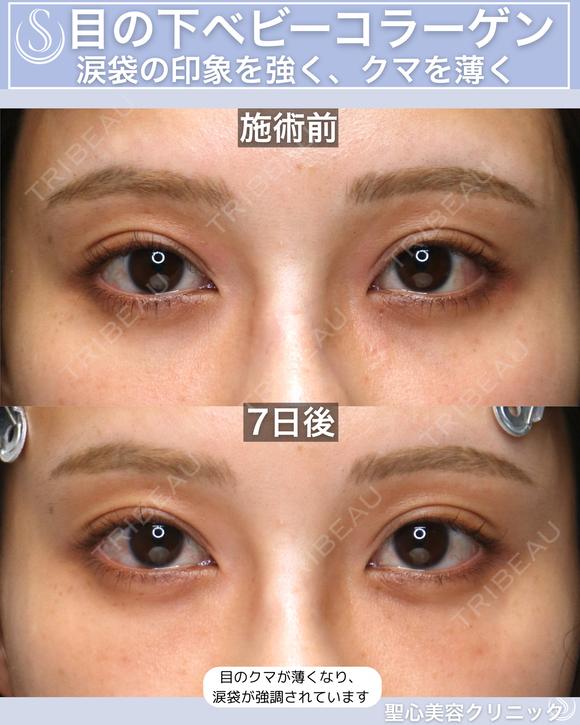 【20代女性】目の下のクマを薄く：ベビーコラーゲン 7日後 メイン用