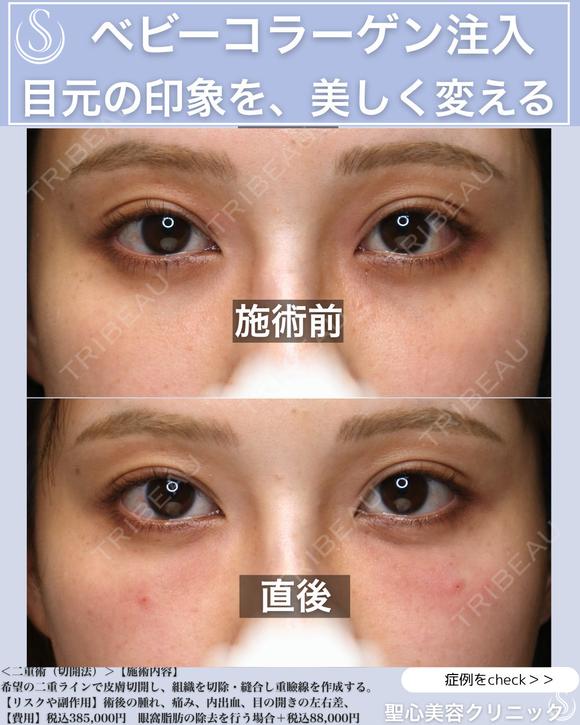 【20代女性】目の下のクマを薄く：ベビーコラーゲン before画像 メイン用
