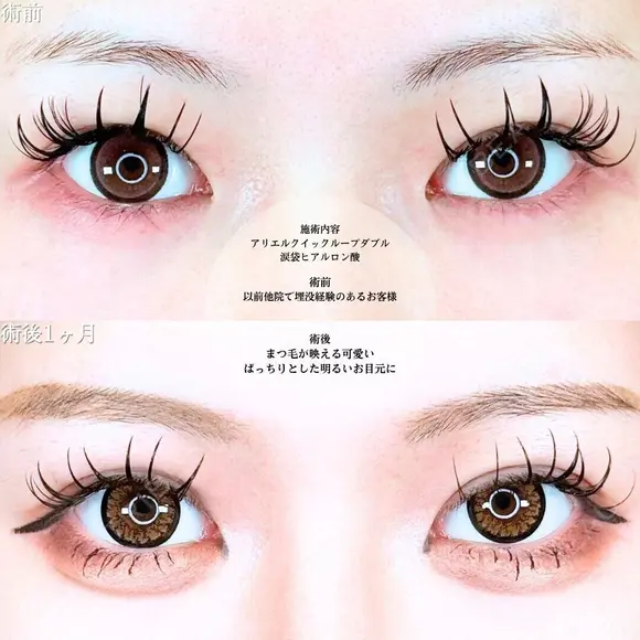 アリエルクイックループダブル二重埋没法/涙袋ヒアルロン酸 before画像 メイン用