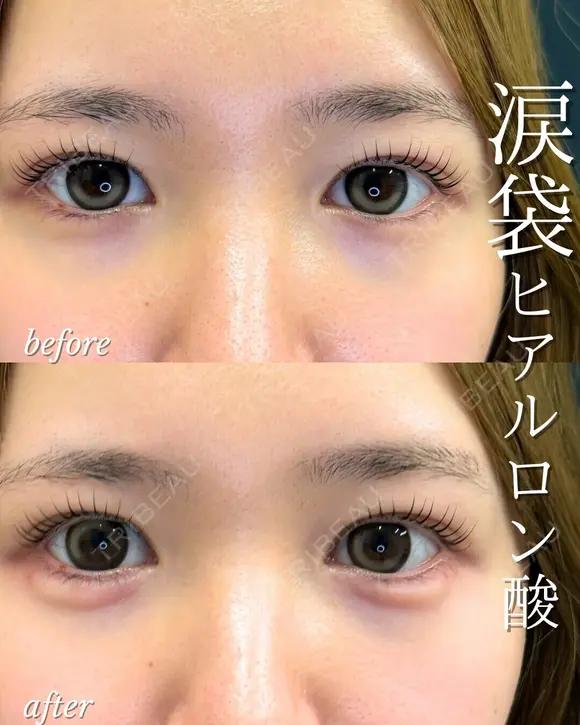 涙袋ヒアルロン酸 before画像 メイン用