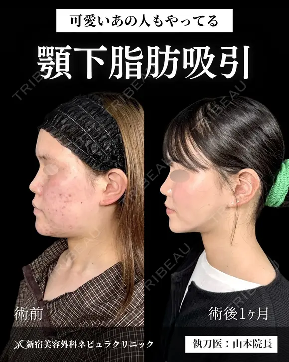 山本による🎀脂肪吸引🎀 before画像 メイン用