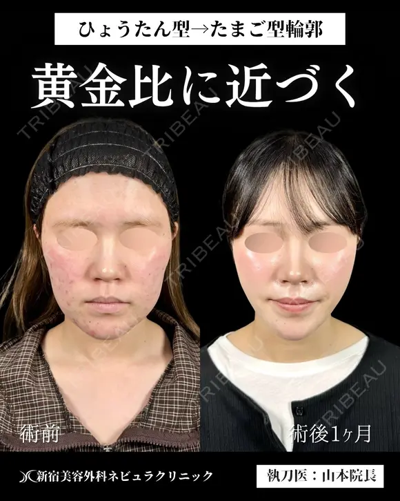 山本による🎀脂肪吸引🎀 30日後 メイン用