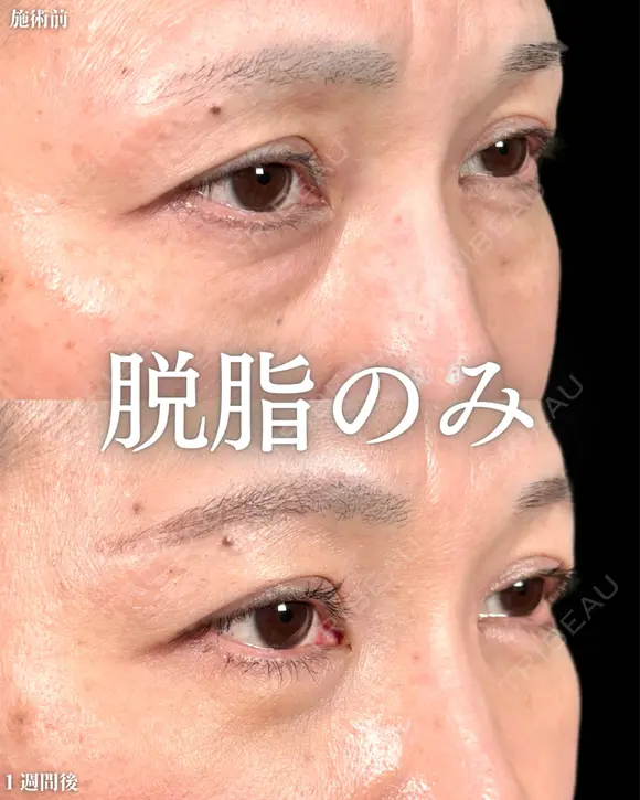 山本による【クマ治療】 7日後 メイン用