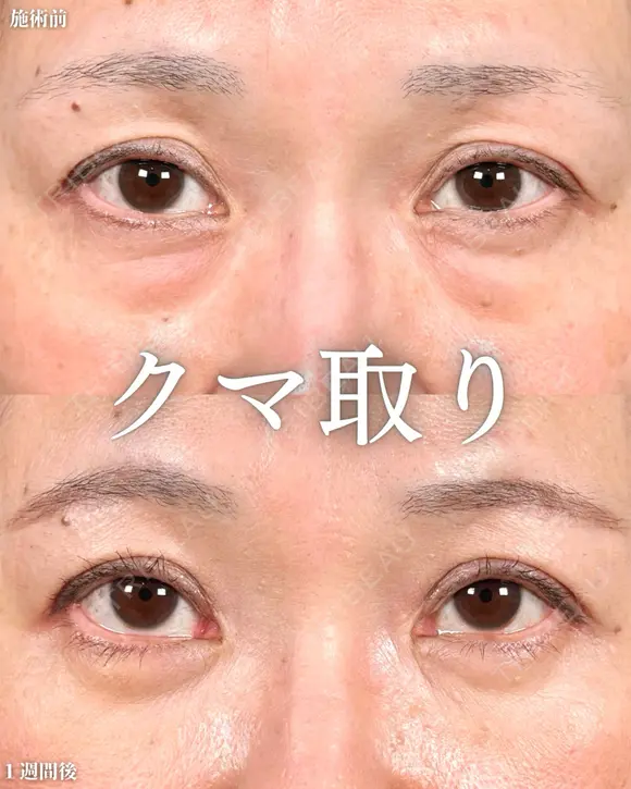 山本による【クマ治療】 before画像 メイン用