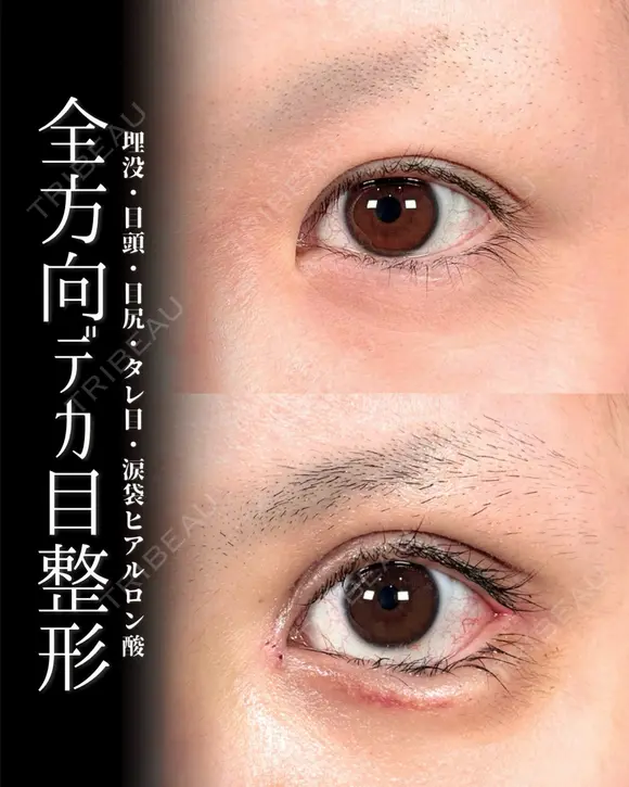 デカ目整形 after画像 メイン用