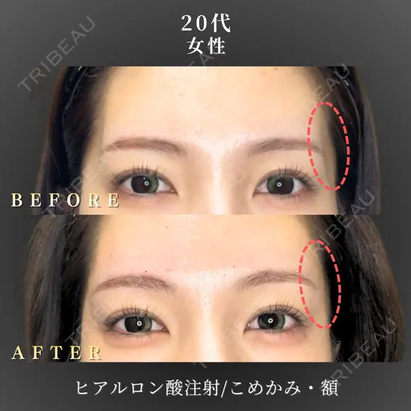 ヒアルロン酸注入/こめかみ after画像 メイン用