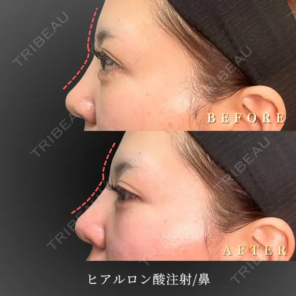ヒアルロン酸注入/鼻 before画像 メイン用