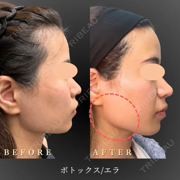 エラボトックス after画像 メイン用
