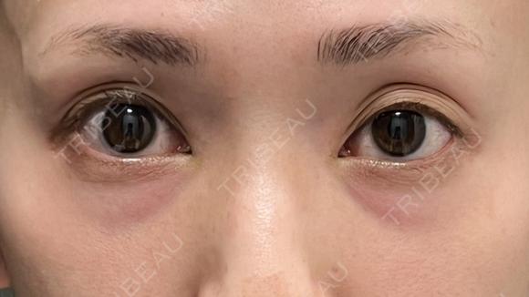 切らない目の下のたるみ取り＋コンデンスリッチ脂肪注入 before画像 メイン用
