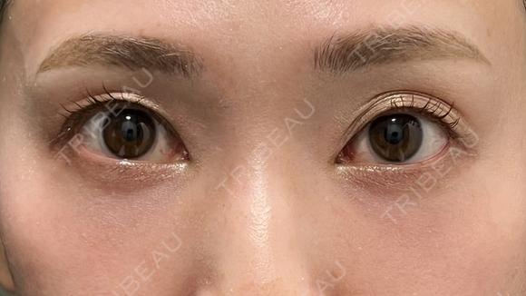 切らない目の下のたるみ取り＋コンデンスリッチ脂肪注入 30日後 メイン用