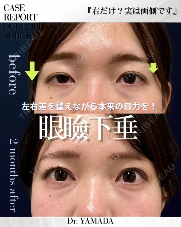 【眼瞼下垂】左右差を整え整えながら本来の目力を 60日後 メイン用