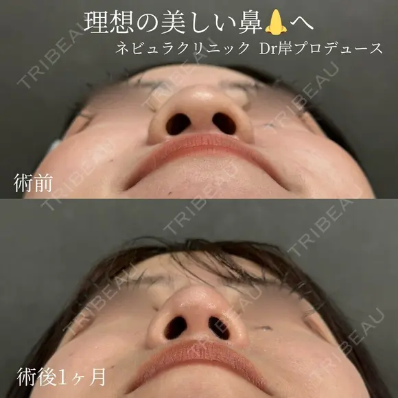 理想の忘れ鼻に✨ 30日後 メイン用