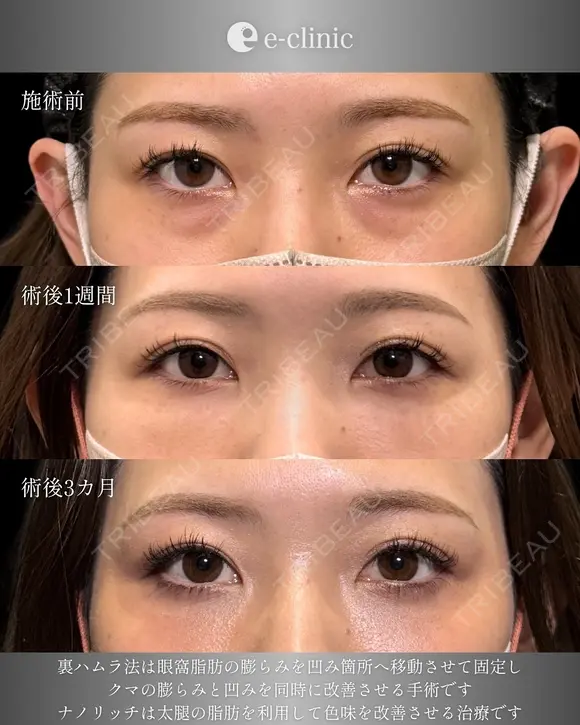 裏ハムラ before画像 メイン用