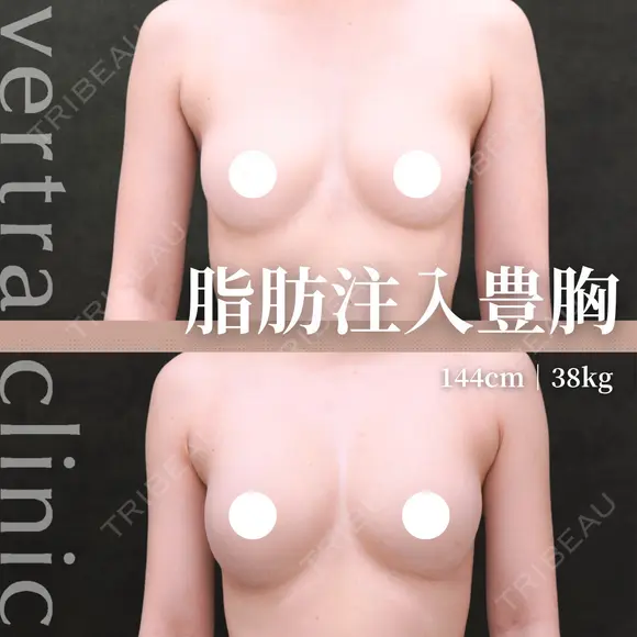 脂肪注入豊胸 30日後 メイン用