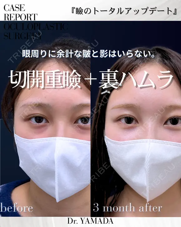 【二重切開＆裏ハムラ】目周りをトータルで整える 90日後 メイン用