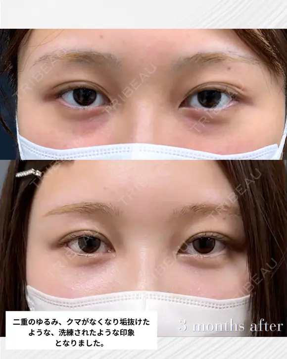 【二重切開＆裏ハムラ】目周りをトータルで整える 90日後 メイン用