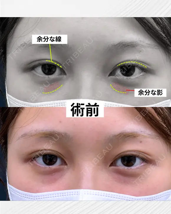 【二重切開＆裏ハムラ】目周りをトータルで整える before画像 メイン用