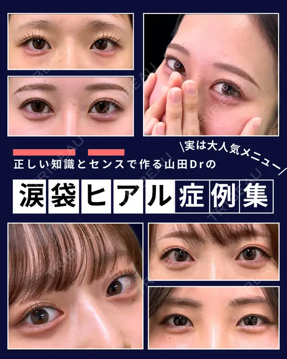 【涙袋ヒアルロン酸】大人気メニュー 0日後 メイン用