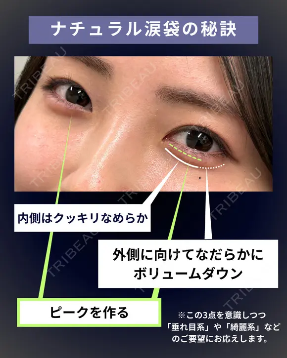 【涙袋ヒアルロン酸】大人気メニュー 0日後 メイン用