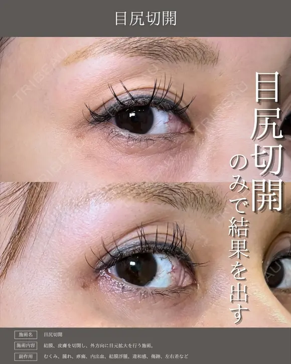 目尻切開 before画像 メイン用