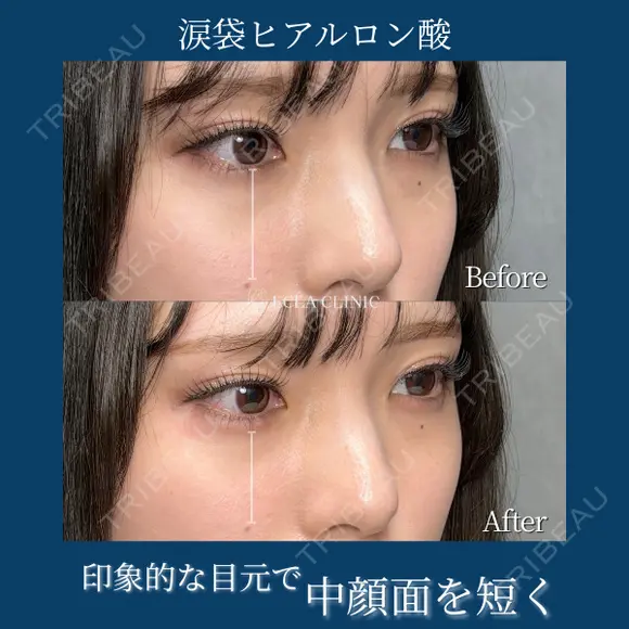 涙袋　ヒアルロン酸（ボルベラ） before画像 メイン用
