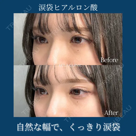涙袋　ヒアルロン酸（ボルベラ） after画像 メイン用
