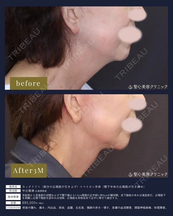 【女性・首もとを深層から整える】ネックリフト＋ペリカン手術（3ヶ月） 90日後 メイン用