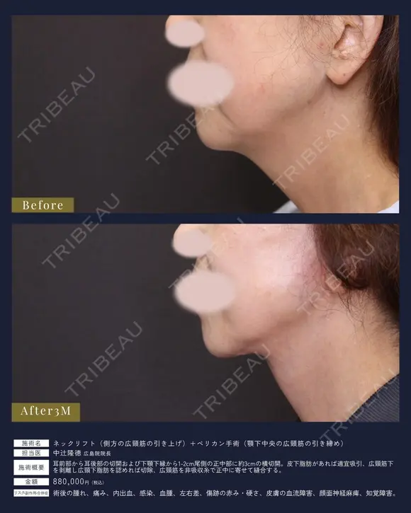 【女性・首もとを深層から整える】ネックリフト＋ペリカン手術（3ヶ月） 90日後 メイン用