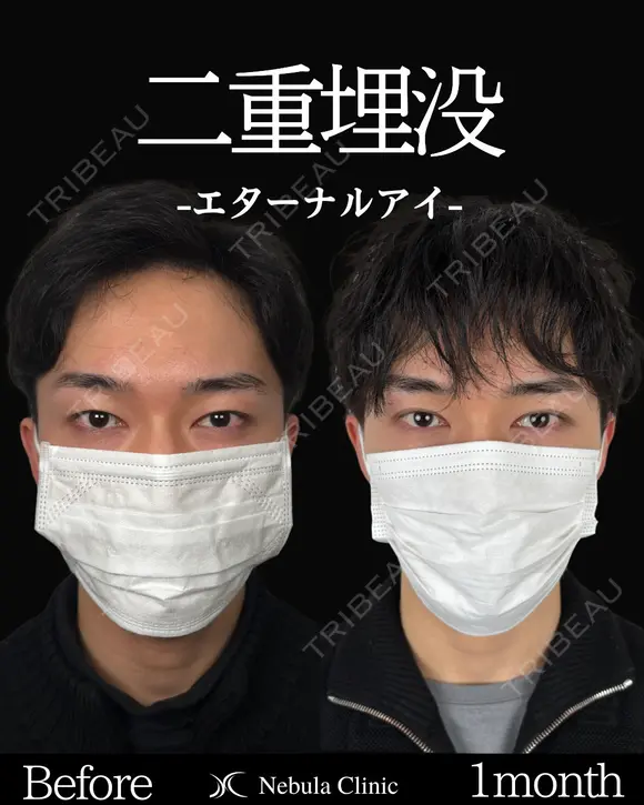 Dr岩切💝二重埋没💝 before画像 メイン用