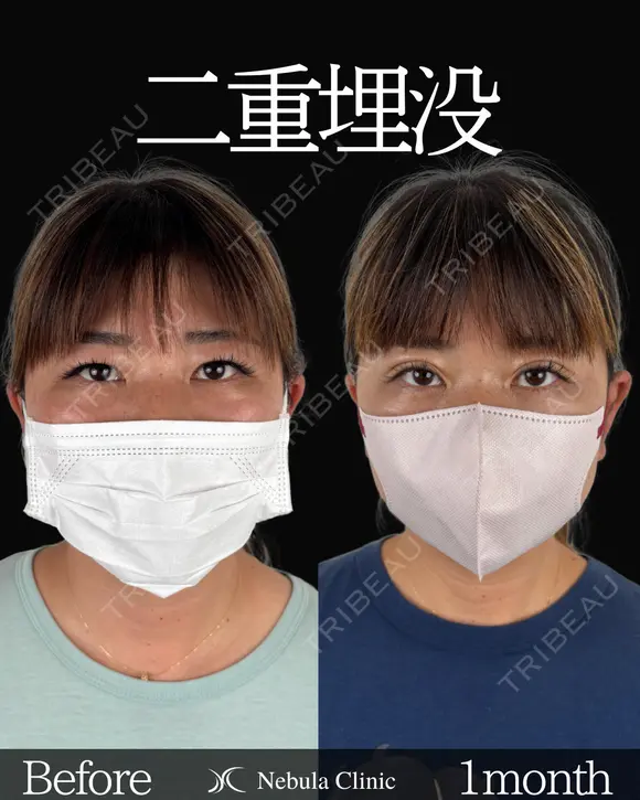 Dr岩切💝二重埋没💝 before画像 メイン用