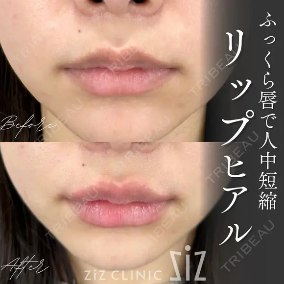 【唇ヒアル】ふっくら唇で人中短縮 after画像 メイン用