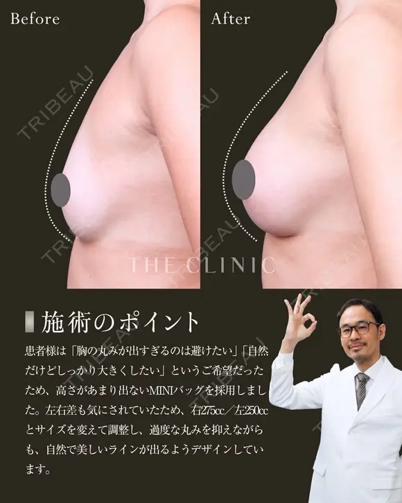 しっかりサイズアップしたのに美しく馴染む胸元✨｜プレミアムハイブリッド豊胸 after画像 メイン用