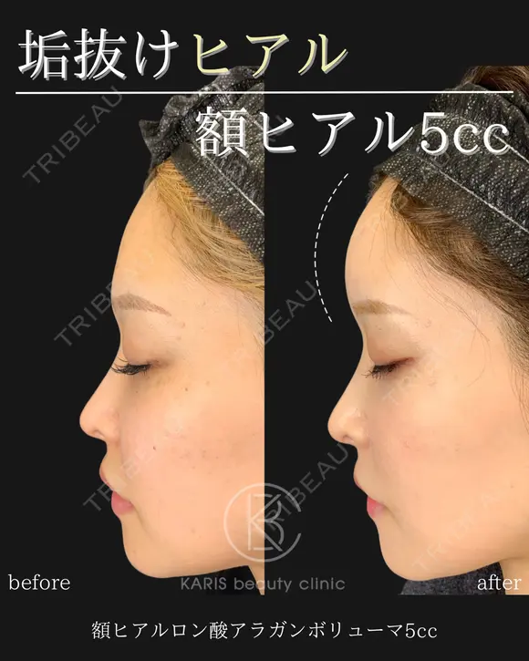 額ヒアルロン酸 after画像 メイン用