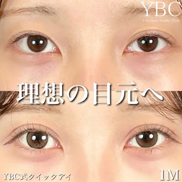 【🍩YBC式クイックアイ🍩】 before画像 メイン用