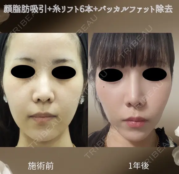 サクションリフト＋バッカルファット除去 365日後 メイン用