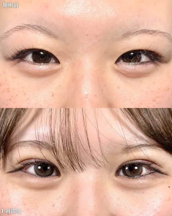 二重埋没＋ before画像 メイン用