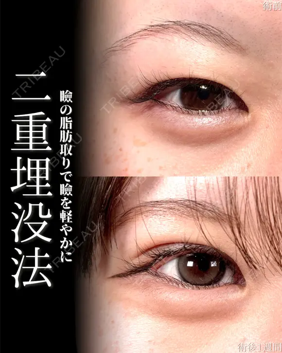 二重埋没＋ 7日後 メイン用