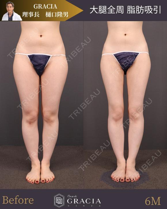 ベイザー太腿全周脂肪吸引 before画像 メイン用