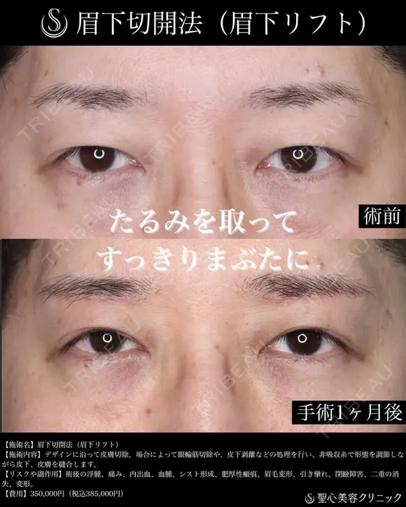 【40代男性・1か月後】眉下切開法（眉下リフト） before画像 メイン用