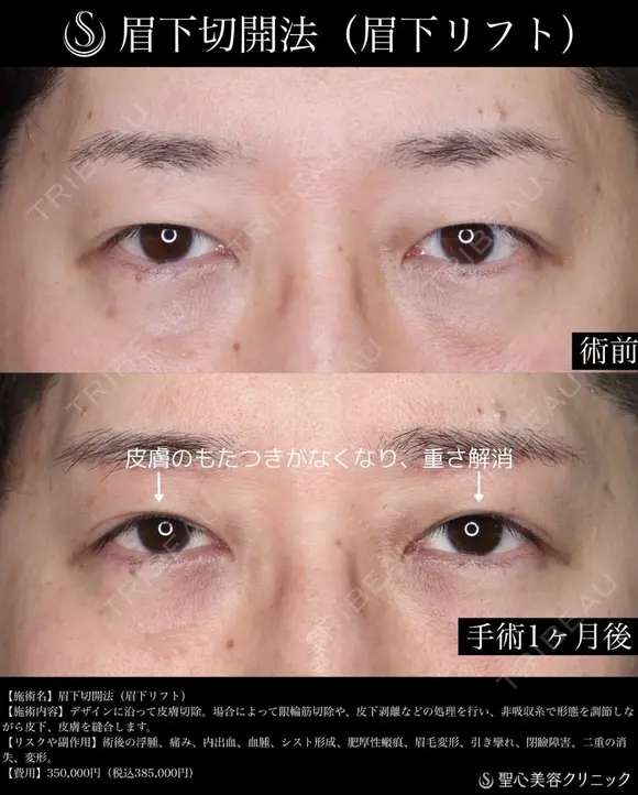【40代男性・1か月後】眉下切開法（眉下リフト） 30日後 メイン用