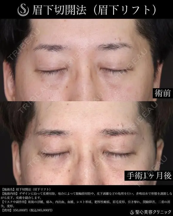 【40代男性・1か月後】眉下切開法（眉下リフト） 30日後 メイン用
