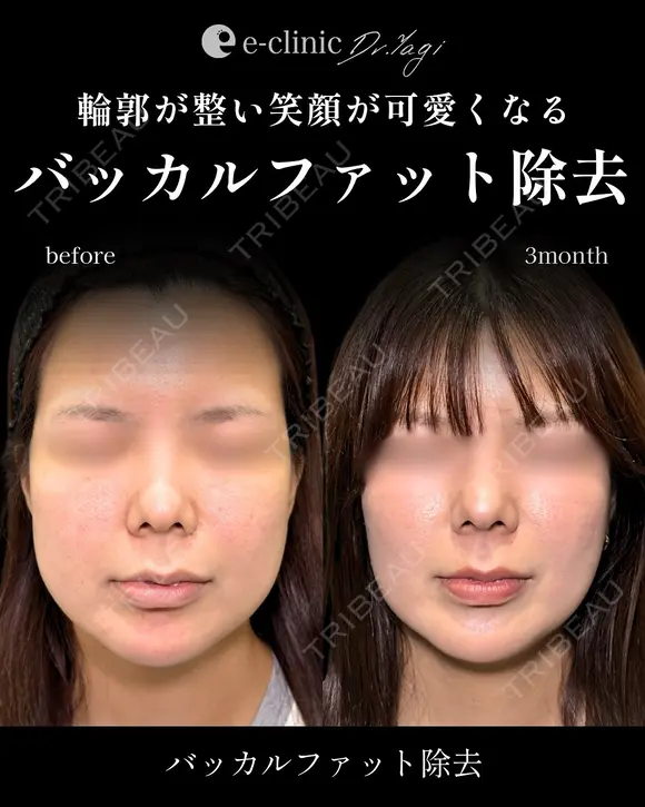 バッカルファット after画像 メイン用