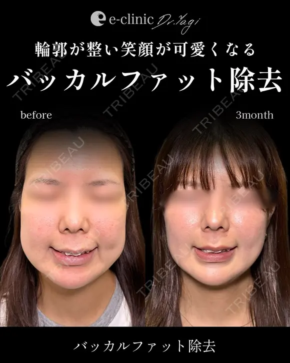 バッカルファット before画像 メイン用