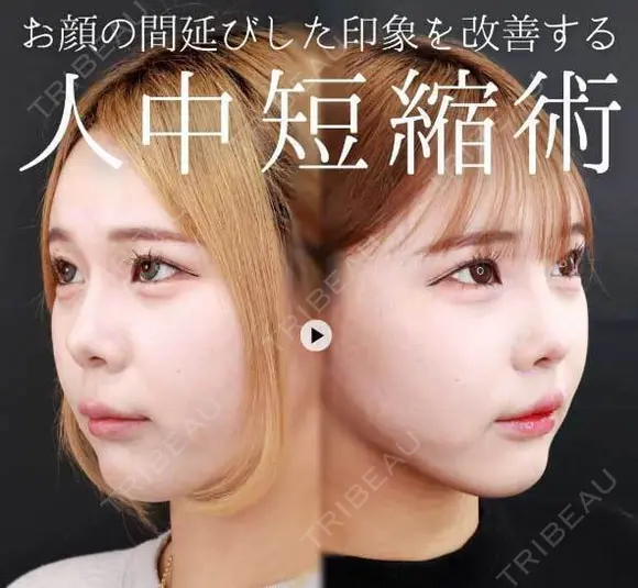 TAC式人中短縮術 30日後 メイン用