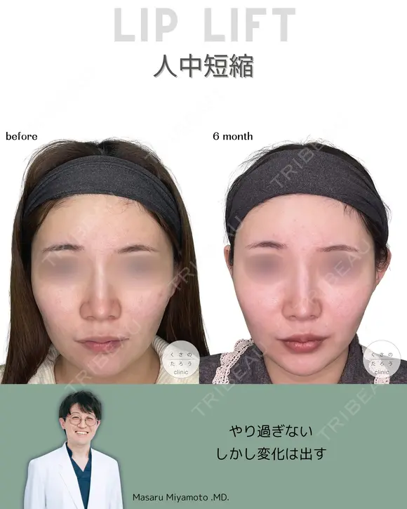 人中短縮（リップリフト） before画像 メイン用
