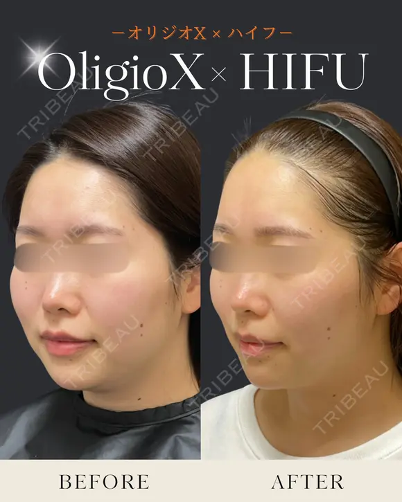 オリジオX+ウルトラセルZiリニアハイフ before画像 メイン用