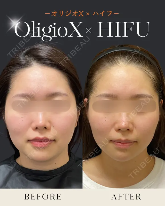 オリジオX+ウルトラセルZiリニアハイフ after画像 メイン用