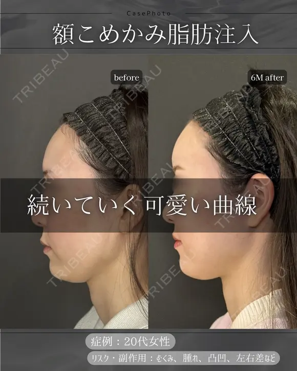 脂肪注入(額、こめかみ) before画像 メイン用