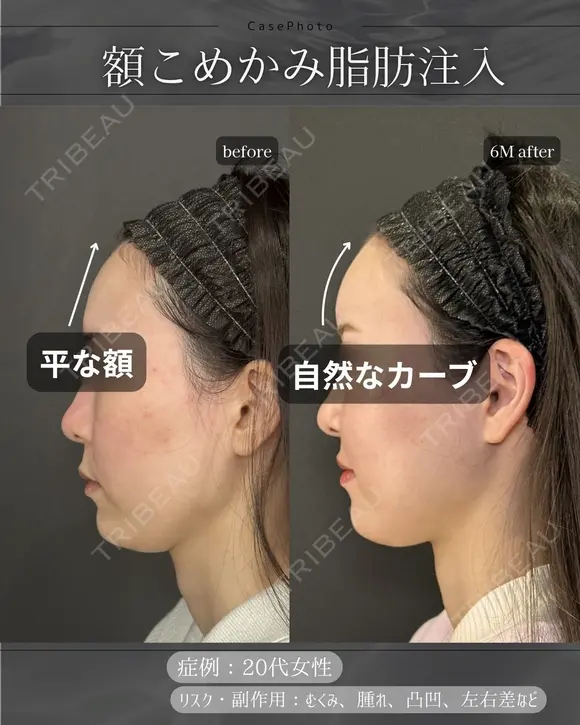 脂肪注入(額、こめかみ) after画像 メイン用