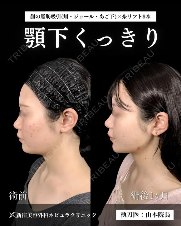 顔の脂肪吸引 before画像 メイン用